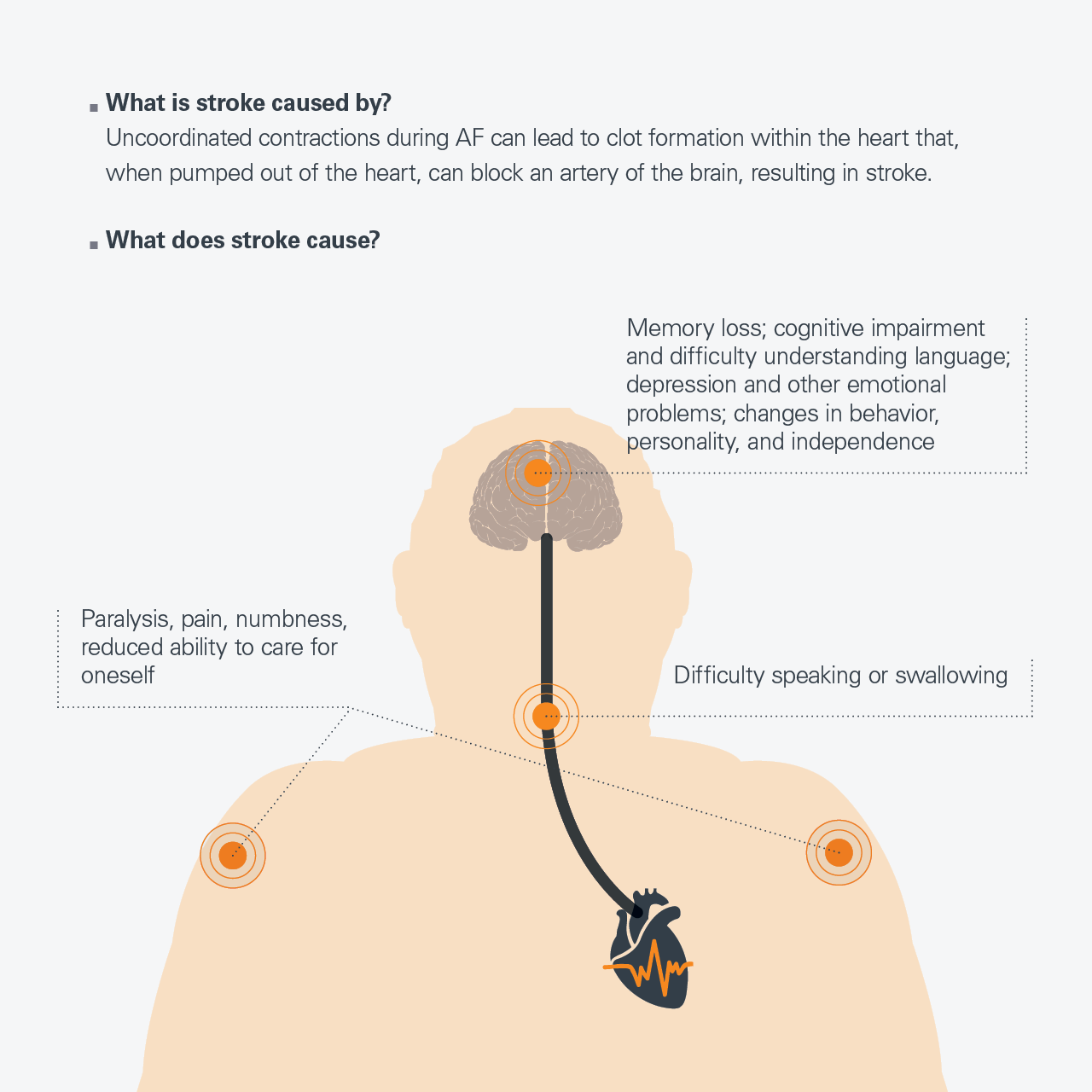 Assessing stroke risk in Atrial Fibrillation patients