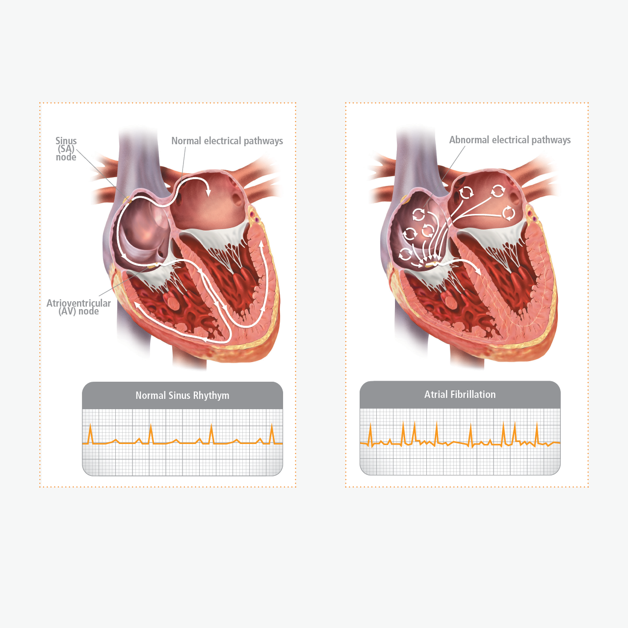afib