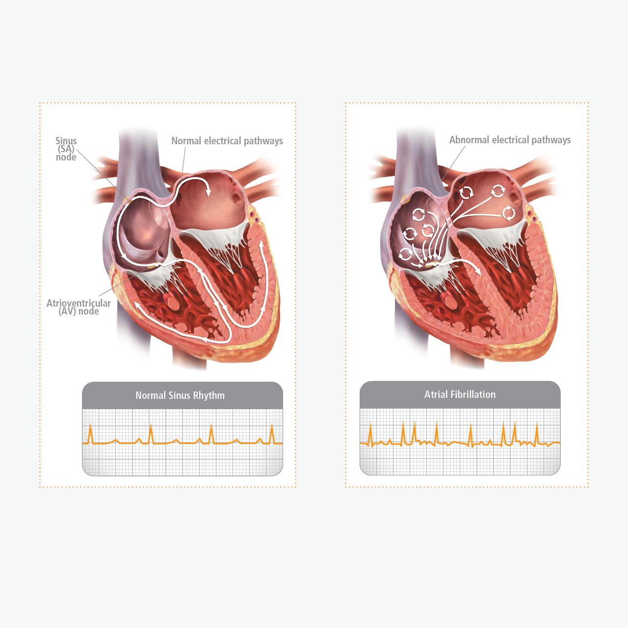 How Is Atrial Fibrillation Characterized