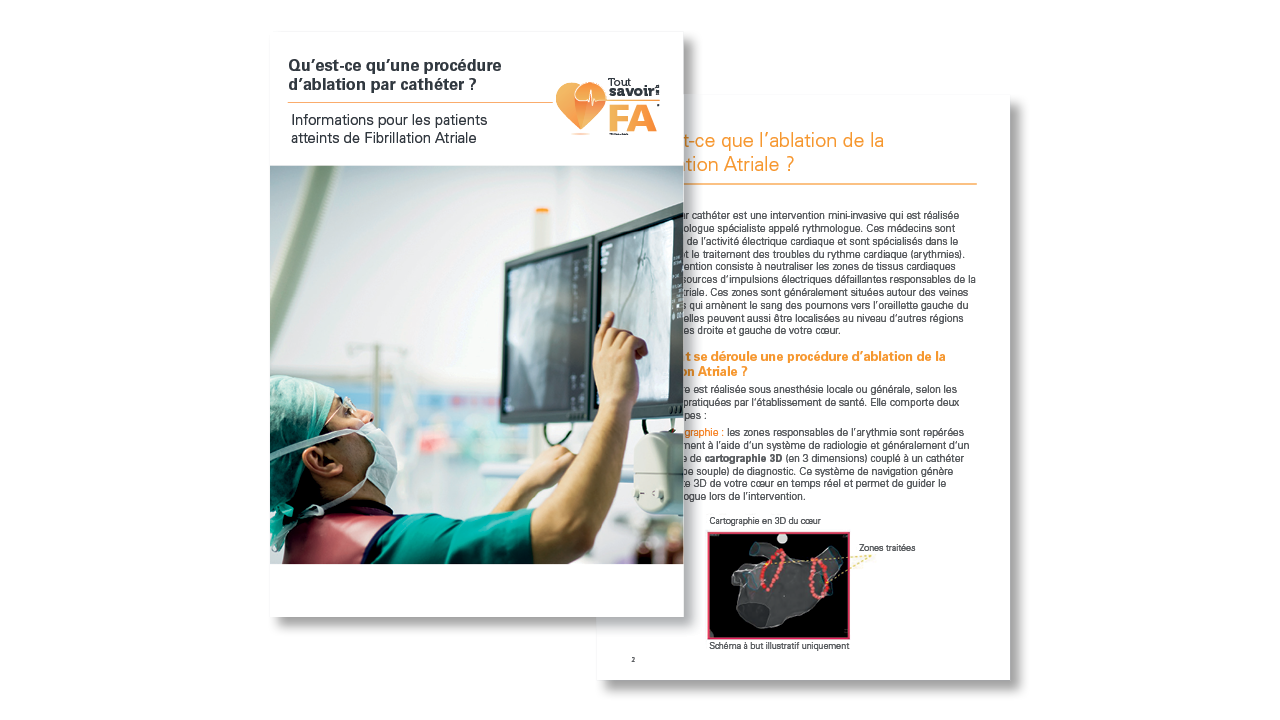 Informations pour les patients atteints de Fibrillation Atriale:  Qu’est-ce qu’une procédure d’ablation par cathéter ?