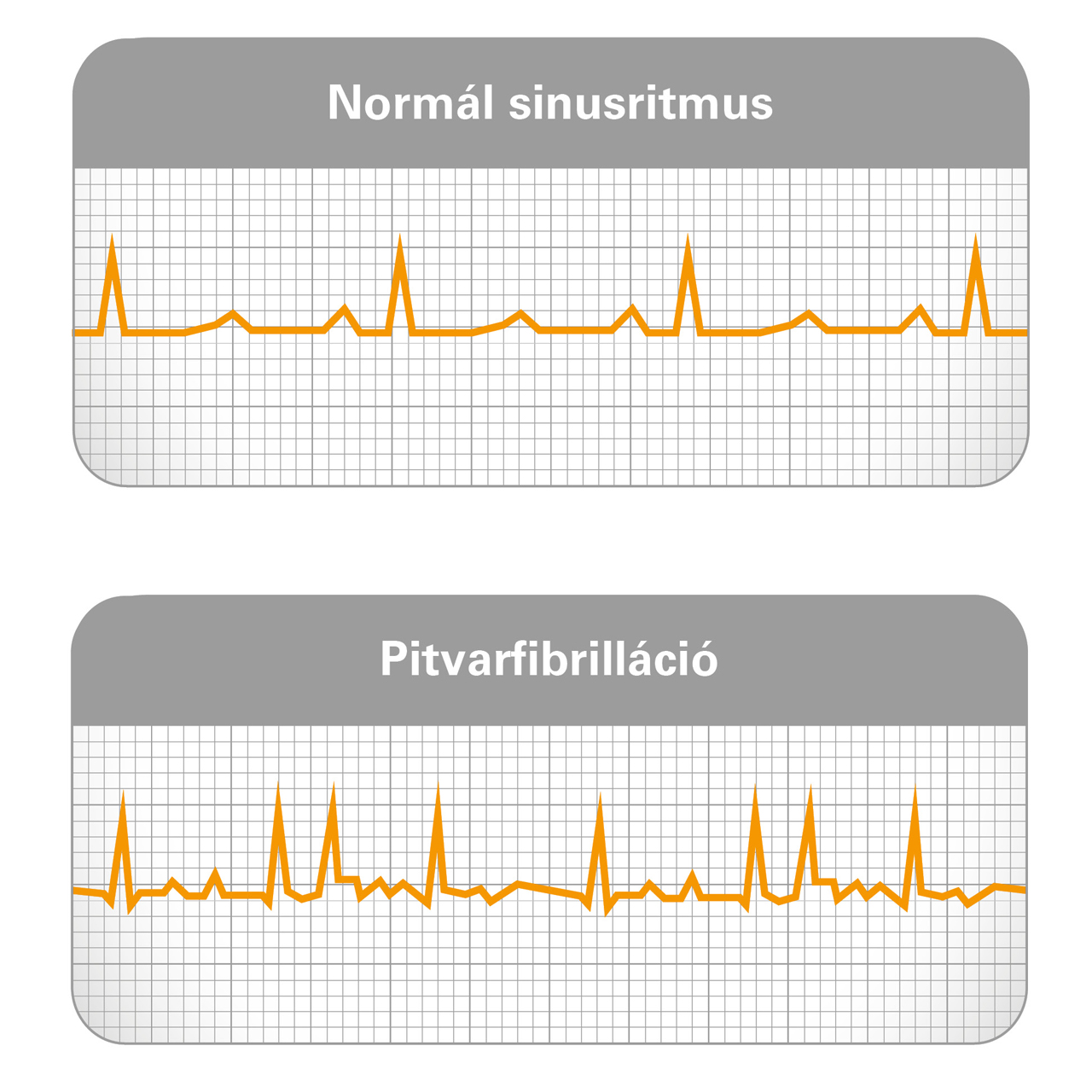 pitvarfibrilláció és flutter jelentése