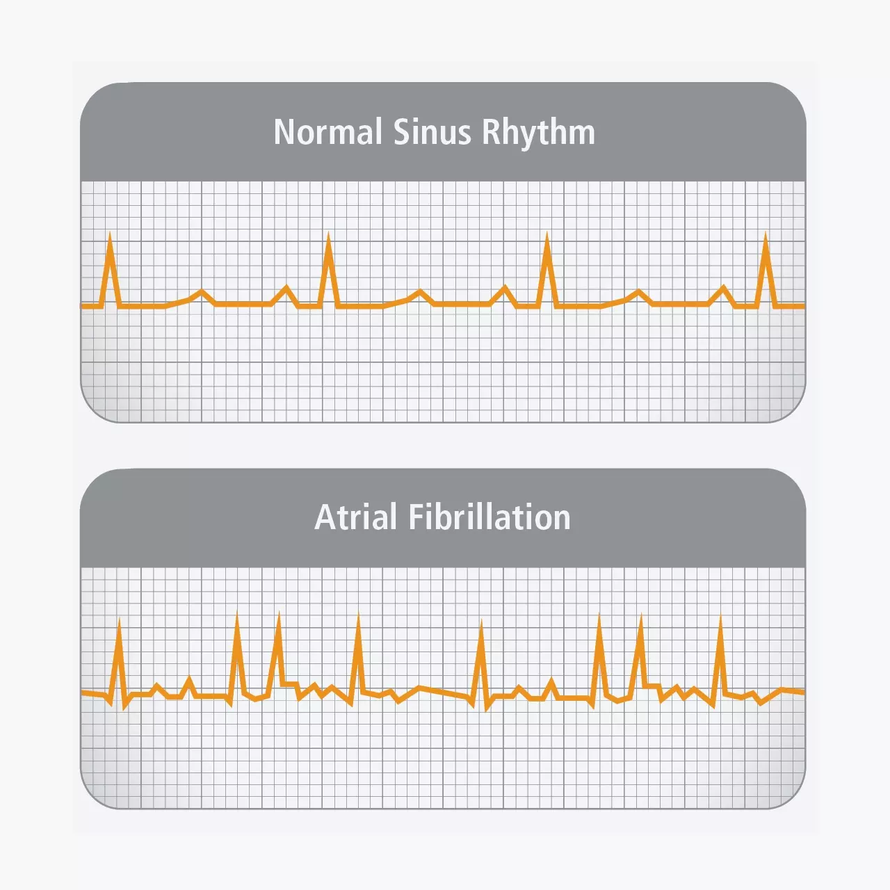 Atrial Fibrillation Graph